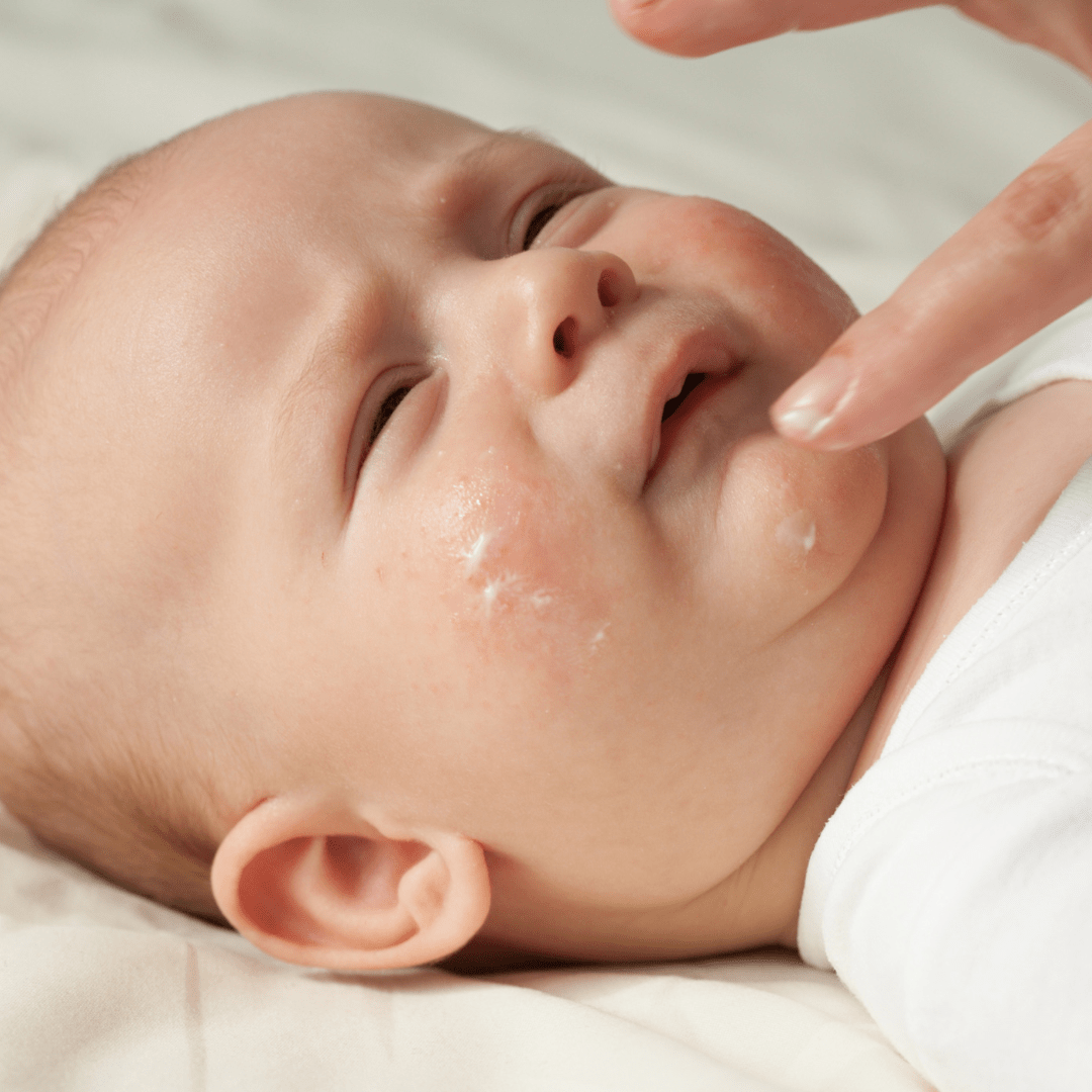 Newborn Eczema: How to Spot It Early and Help Your Baby Feel Better - The Wee Bean