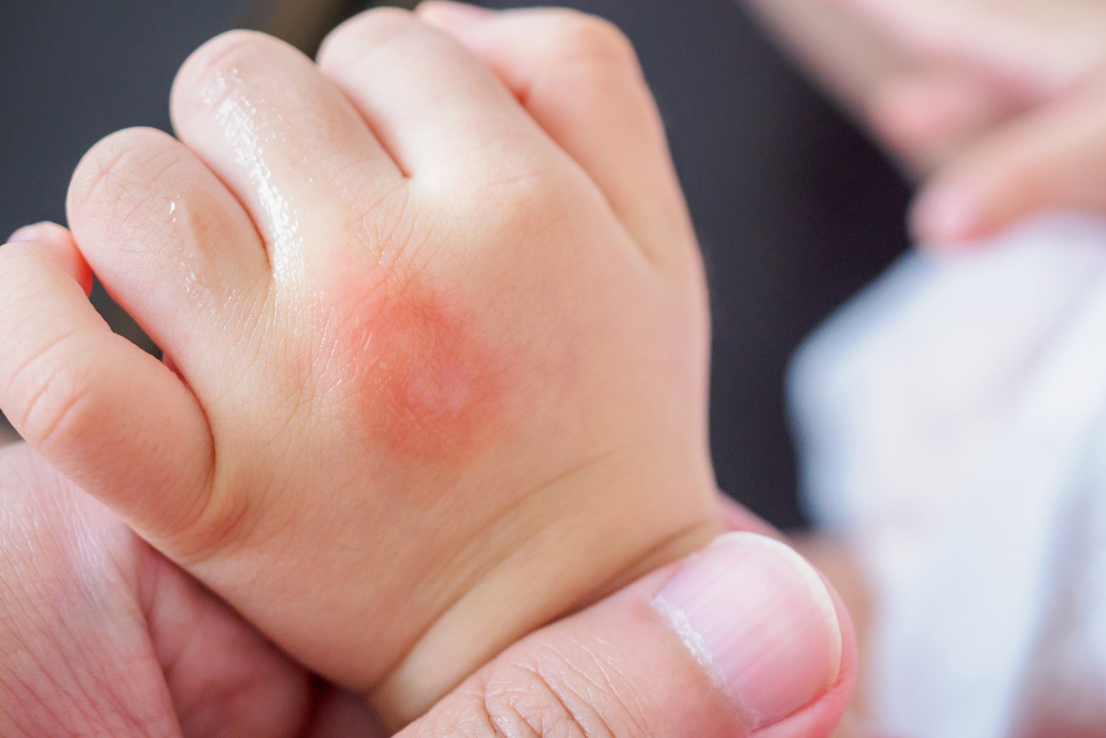 Baby Eczema 101: Causes, Symptoms, and Treatment - The Wee Bean