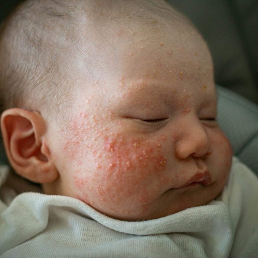 4 Natural Remedies For Baby's Eczema: What Every Parent Should Know - The Wee Bean