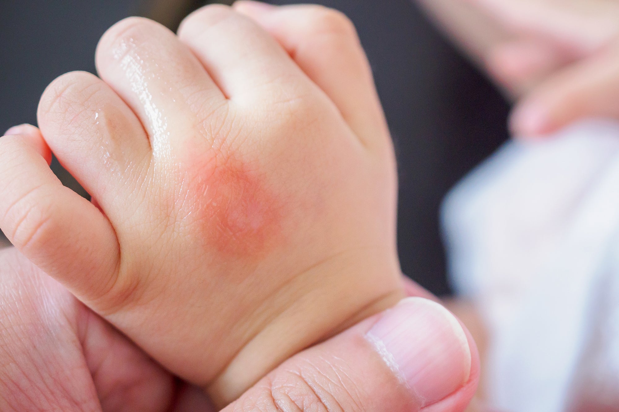Baby Eczema on Infant Hand