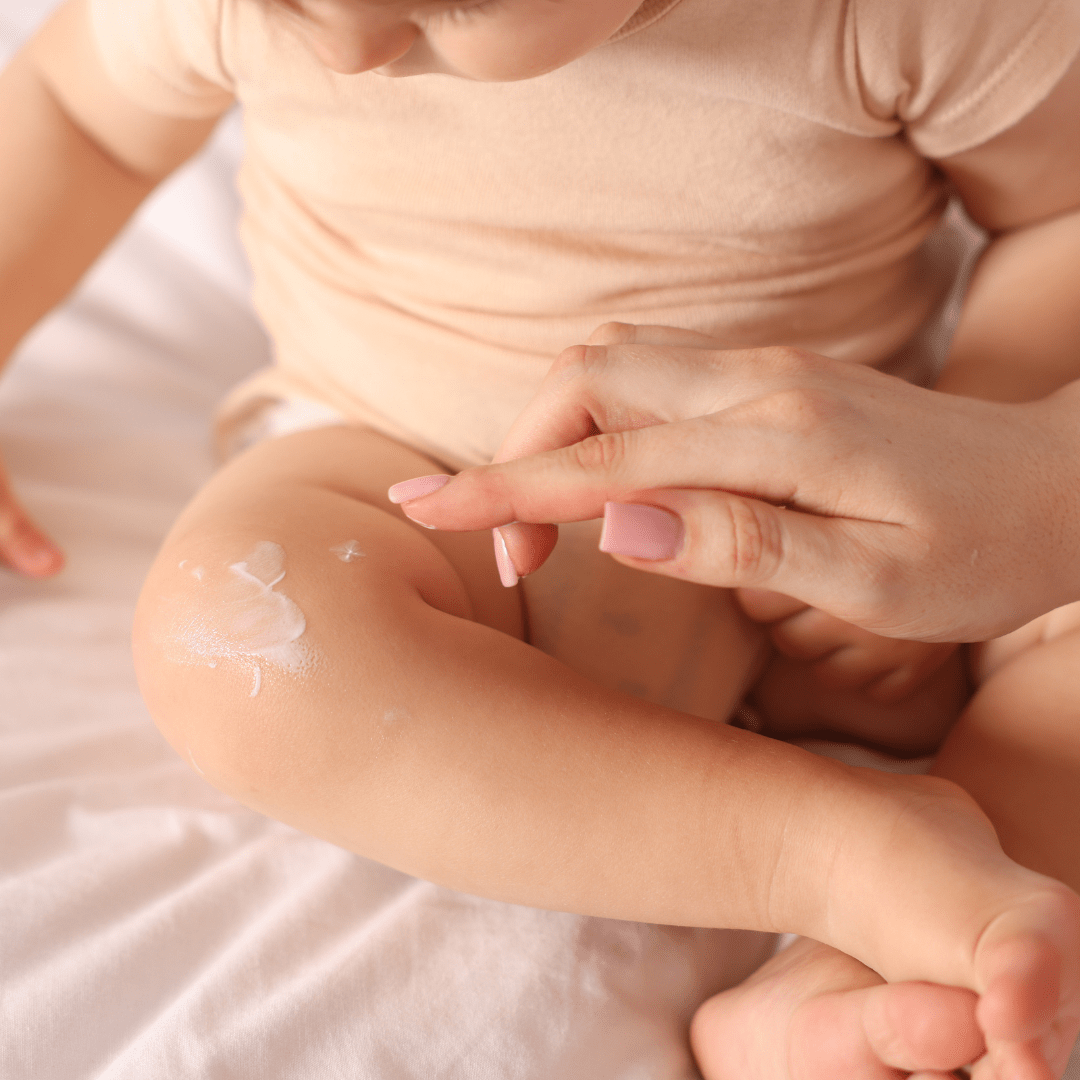 Putting eczema cream on baby's leg