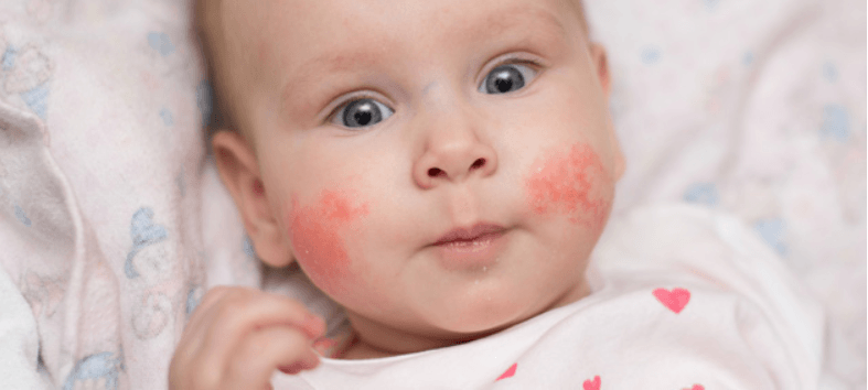 Eczema: Top 5 Tips in Preventing and Treating a Breakout