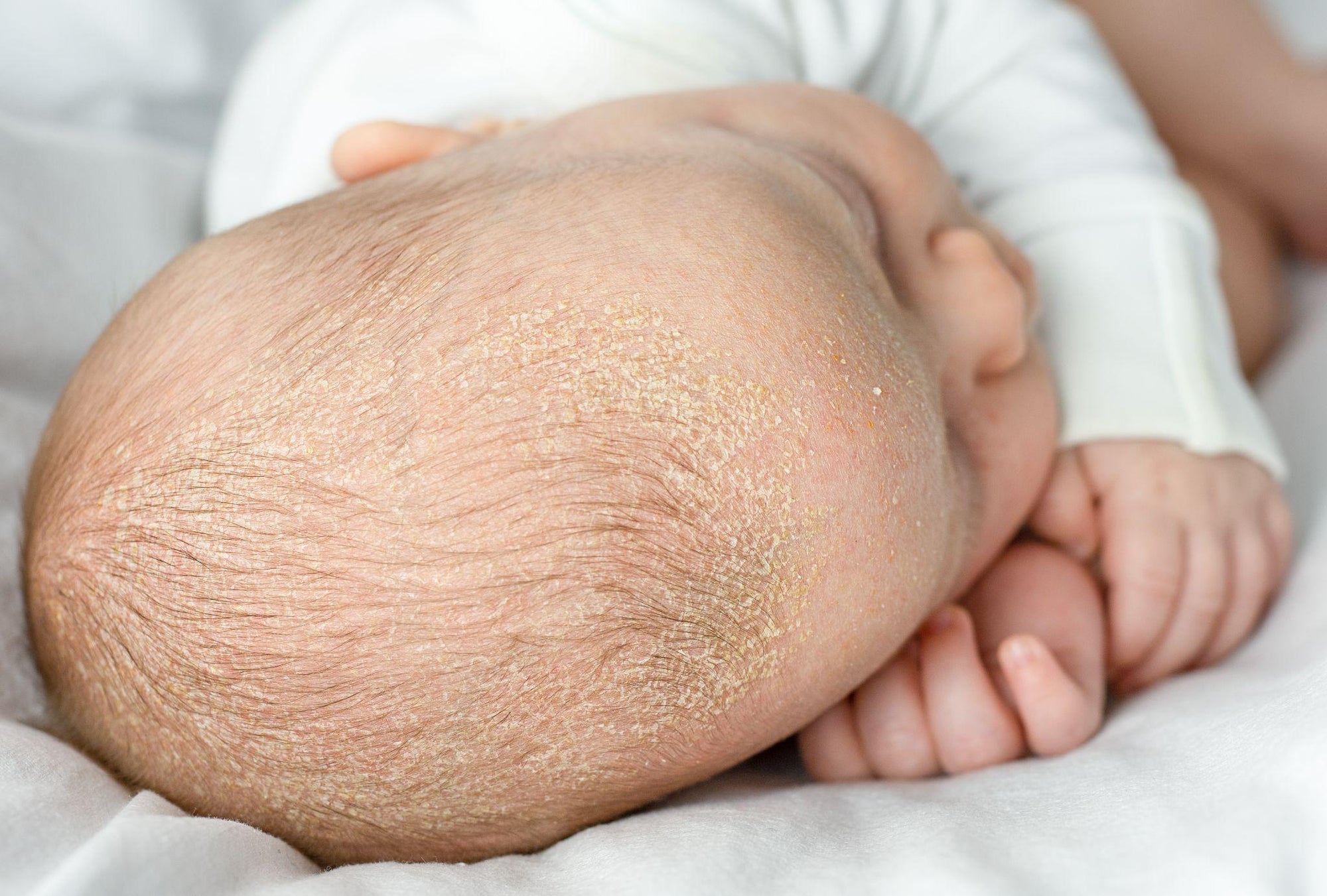 baby with cradle cap the wee bean